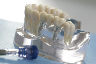 Implantate